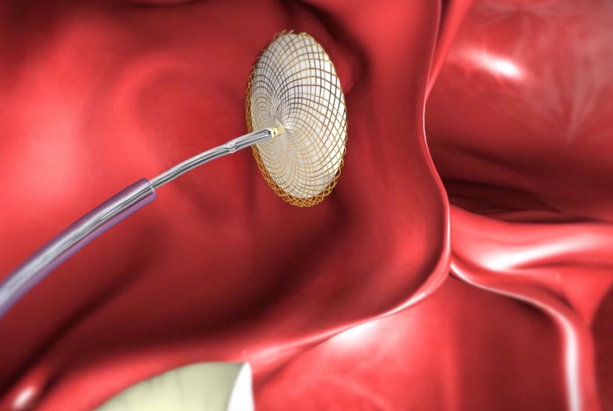 Background image for Accès direct au film FOP : La fermeture de foramen ovale perméable