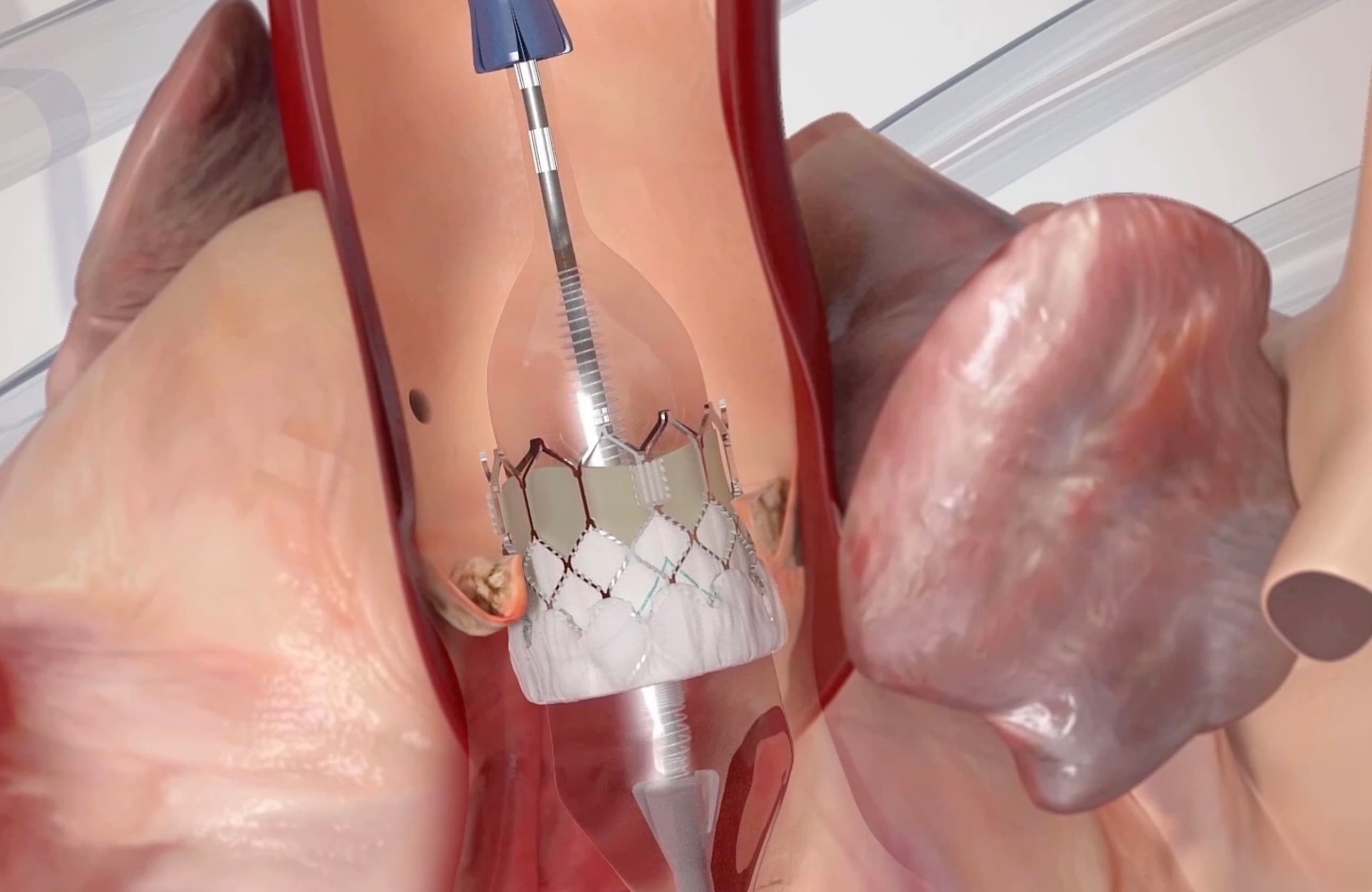 Background image for Accès direct au film TAVI : Valve cardiaque mini invasive